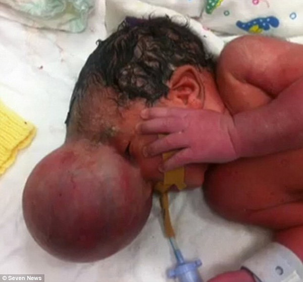 珀斯男婴出生时大脑竟长在头骨外 奇迹恢复医生都被他震撼 - 1