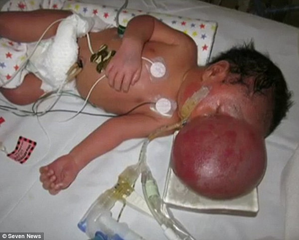 珀斯男婴出生时大脑竟长在头骨外 奇迹恢复医生都被他震撼 - 2