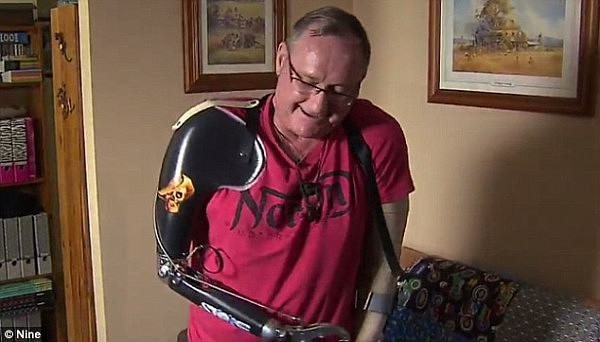 澳洲断臂男申请残疾人福利金遭拒 Centrelink：你还有另一只胳膊呢！ - 2
