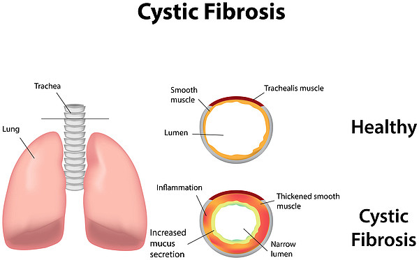 cystic-fibrosis-lung.jpeg,0