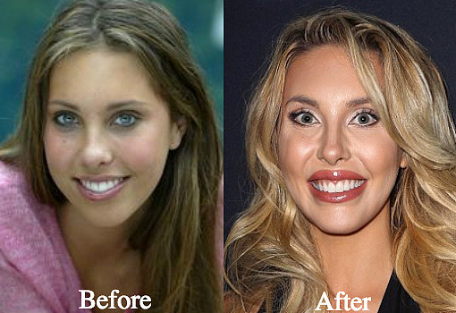 Chloe-Lattanzi-Plastic-Surgery-Before-and-After-Photos.jpg,0