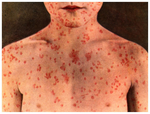 page-42-Does-my-child-have-measles1.jpg,0