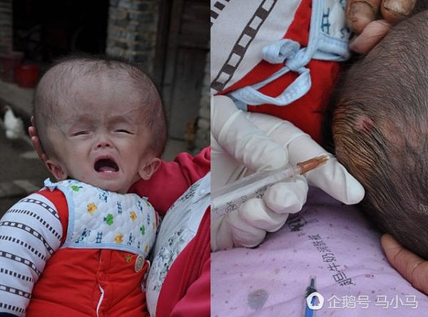 中国男童患病后似外星人 家人用针管插入头部为其“缩颅”（图） - 3