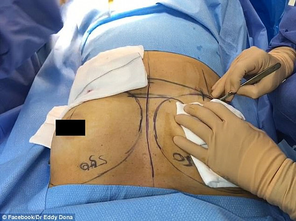 高能慎入！悉尼整形医生Snapchat直播丰胸手术 自称场面“很吓人”！（视频） - 1