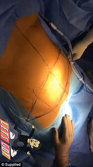 高能慎入！悉尼整形医生Snapchat直播丰胸手术 自称场面“很吓人”！（视频） - 6
