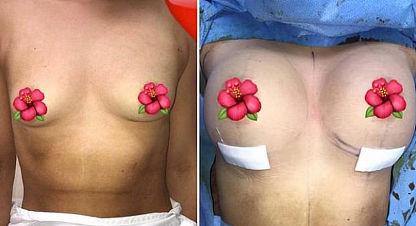 高能慎入！悉尼整形医生Snapchat直播丰胸手术 自称场面“很吓人”！（视频） - 8