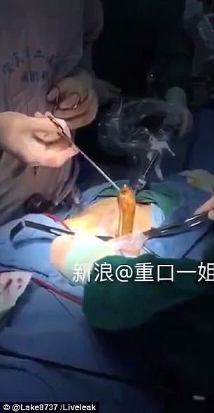 重口慎点！中国男子用黄鳝塞肛门“自慰”险丧命 腹部开刀拉出超长黄鳝澳媒伙呆！(视频) - 2