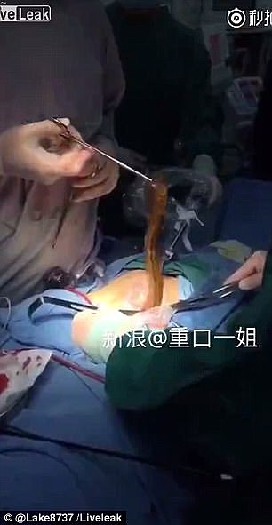 重口慎点！中国男子用黄鳝塞肛门“自慰”险丧命 腹部开刀拉出超长黄鳝澳媒伙呆！(视频) - 3