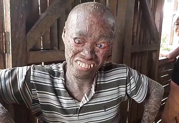 菲律宾一男子患罕见皮肤病被视作邪恶鬼怪（组图） - 1