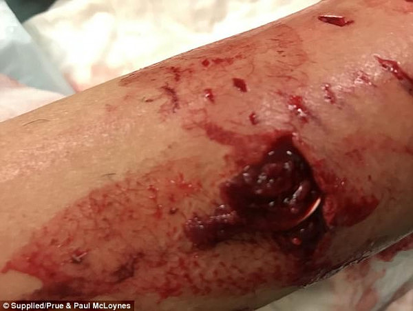 血腥慎点! 悉尼teenager遭恶犬疯狂撕咬 手臂韧带撕裂全身被缝数十针（组图） - 2