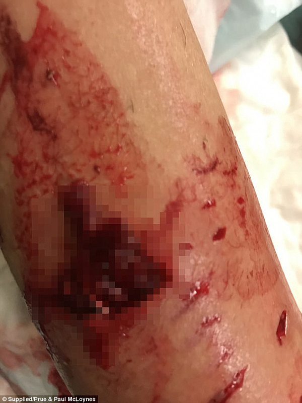 血腥慎点! 悉尼teenager遭恶犬疯狂撕咬 手臂韧带撕裂全身被缝数十针（组图） - 1
