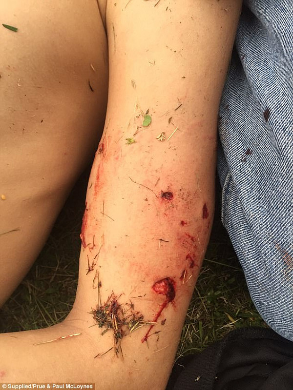 血腥慎点! 悉尼teenager遭恶犬疯狂撕咬 手臂韧带撕裂全身被缝数十针（组图） - 3