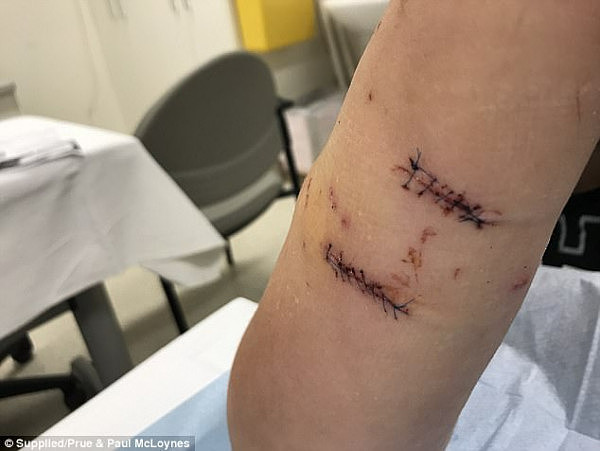 血腥慎点! 悉尼teenager遭恶犬疯狂撕咬 手臂韧带撕裂全身被缝数十针（组图） - 5