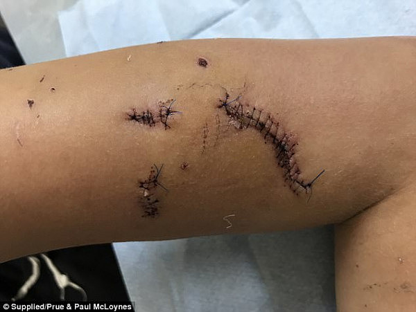 血腥慎点! 悉尼teenager遭恶犬疯狂撕咬 手臂韧带撕裂全身被缝数十针（组图） - 7