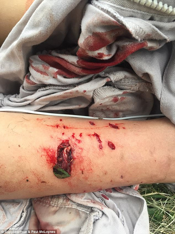 血腥慎点! 悉尼teenager遭恶犬疯狂撕咬 手臂韧带撕裂全身被缝数十针（组图） - 4
