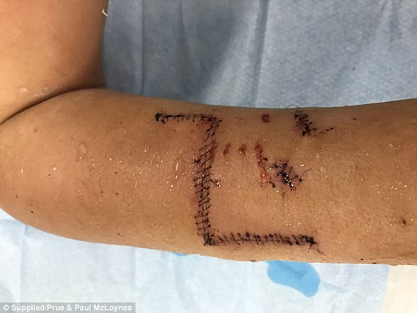 血腥慎点! 悉尼teenager遭恶犬疯狂撕咬 手臂韧带撕裂全身被缝数十针（组图） - 6
