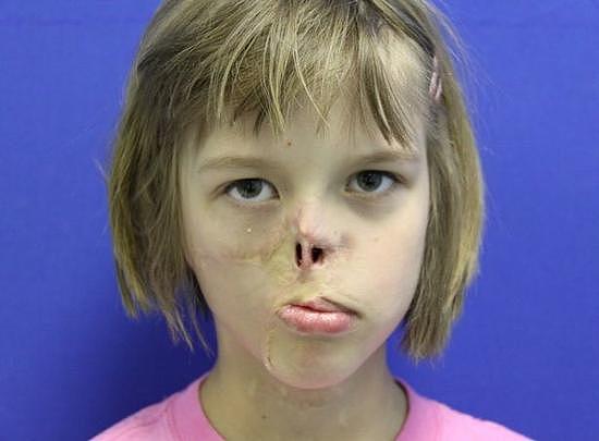 美国女孩被浣熊撕掉半边脸 肋部软骨助其恢复容貌（图） - 2