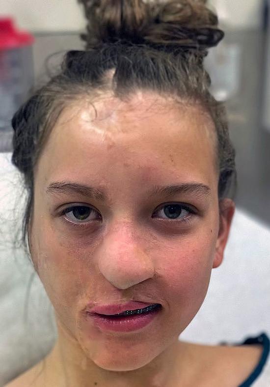 美国女孩被浣熊撕掉半边脸 肋部软骨助其恢复容貌（图） - 5