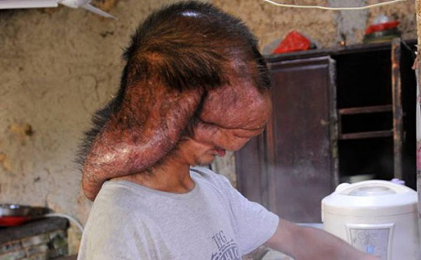 慎入！中国一小伙头上长肿瘤像“墨鱼头” 仅靠嗅觉存活（组图） - 1