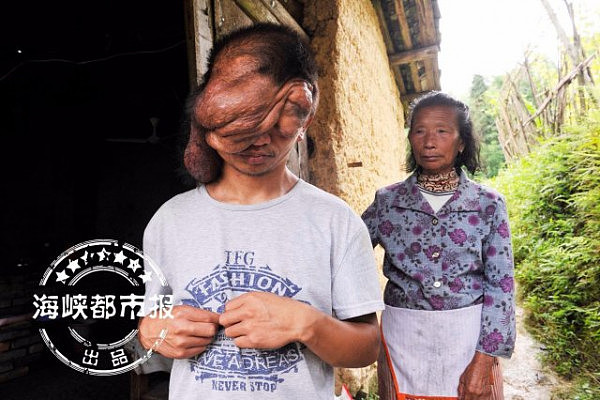慎入！中国一小伙头上长肿瘤像“墨鱼头” 仅靠嗅觉存活（组图） - 3