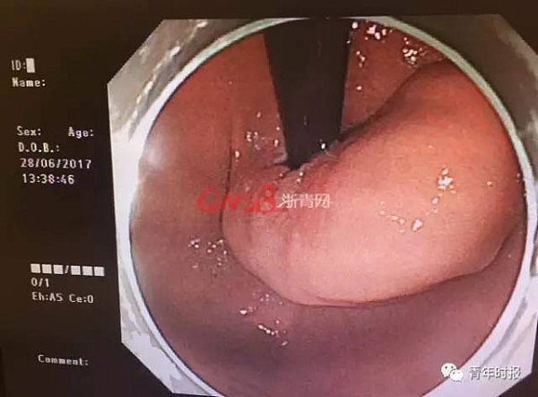 29岁女白领总觉得喉咙痒，医生从她嘴里拖出12厘米长的恐怖异物（组图） - 3