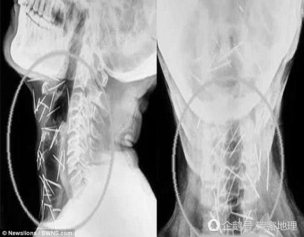 印度男子体藏150根针 自称不记得怎么来的（图） - 4