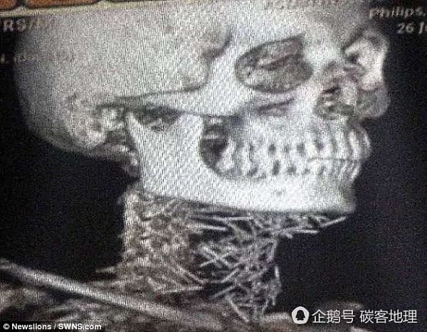 印度男子体藏150根针 自称不记得怎么来的（图） - 5