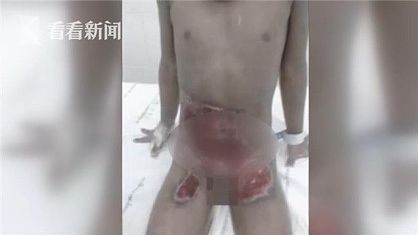 泰国5岁男孩遭泼开水虐待 下体严重烫伤被迫去势（图） - 1