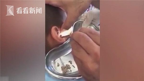 哈萨克斯坦医生为男童挖耳朵 掏出10多条活蛆还在蠕动（视频） - 1