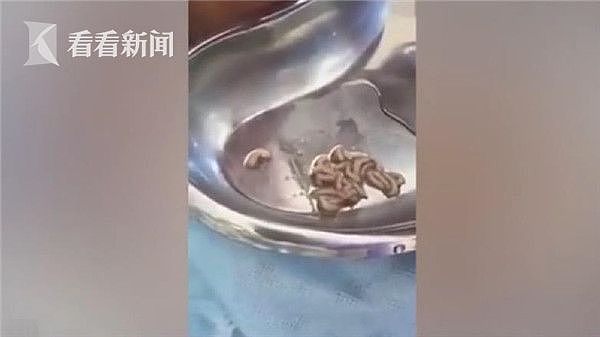 哈萨克斯坦医生为男童挖耳朵 掏出10多条活蛆还在蠕动（视频） - 2