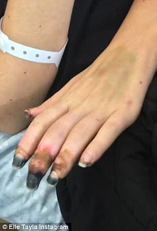 During her stay in hospital, blood pressure medication she was on led to some of the tissue on Ms Lietzow's hands becoming necrotic and dying which meant three of her fingers needed to be amputated