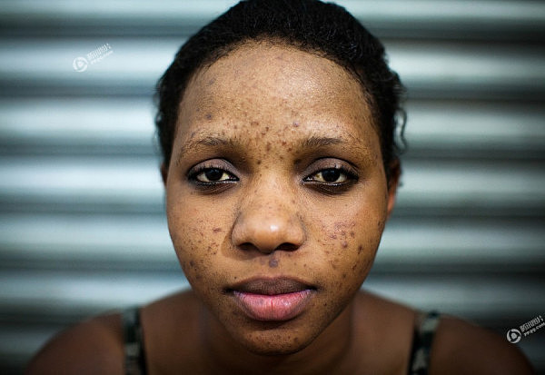 非洲的美白产业：黑人女子为变美将皮肤漂白（组图） - 11
