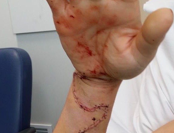 恐怖！澳华裔医生被患者连捅14刀 护士吓得哇哇哭 3年后的他怎么样了... - 2
