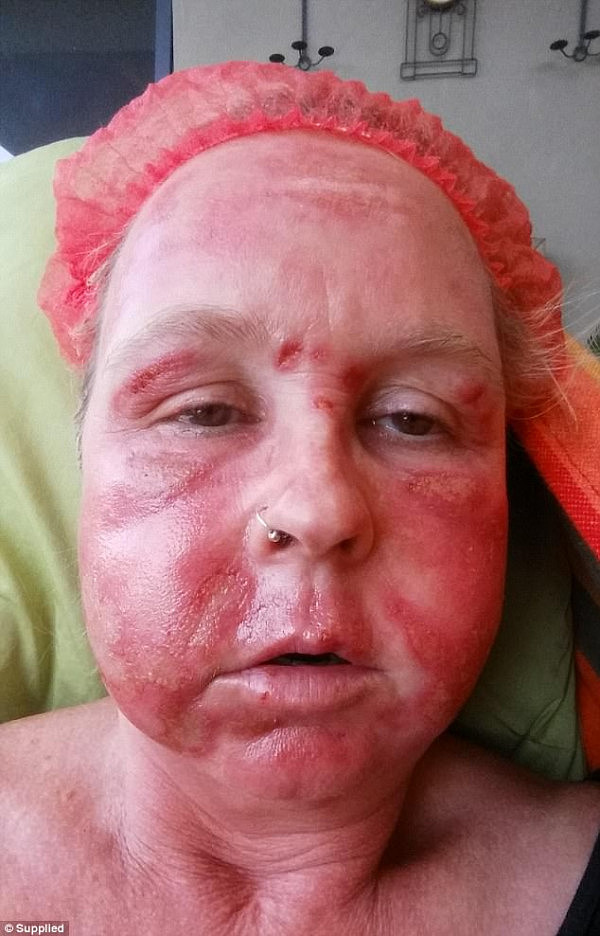 A woman from Melbourne has spoken out about the 'excruciating' pain she was left in, after an erbium laser resurfacing procedure left her face swollen, burnt and 'permanently damaged'