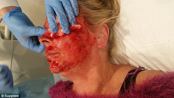 'By the time we left the clinic and got home and the numbing cream had worn off, it was excruciating,' Ms June said (her friend she had the treatment with is pictured here)