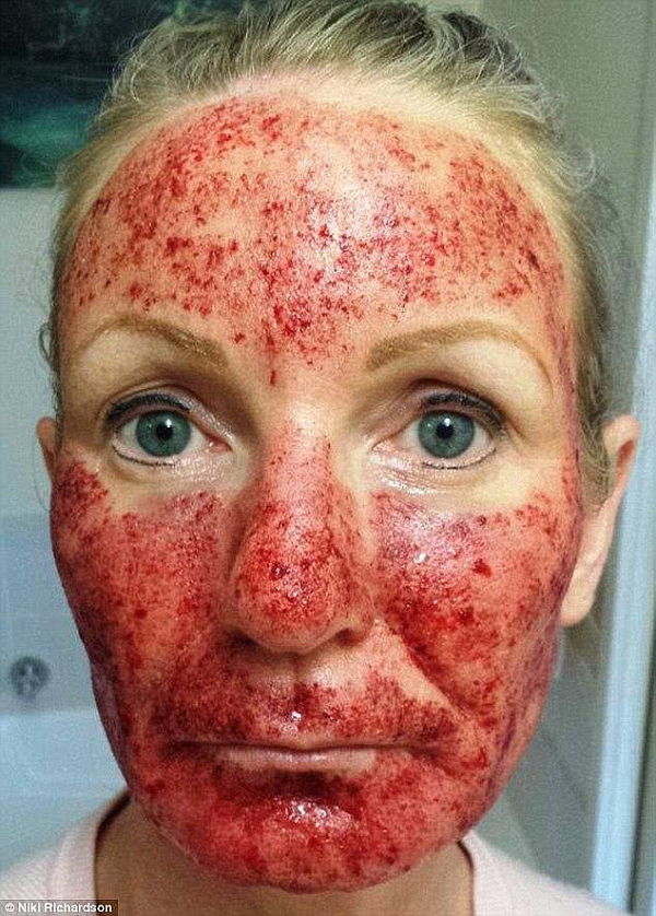 Ms June isn't the only woman who was left with a bloodied face, blistering or swelling following an invasive laser treatment (pictured: Niki Richardson)