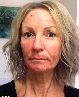 According to Medicine Net , erbium laser resurfacing is designed to remove surface-level and moderately deep lines and wrinkles on the face, hands, neck, or chest (pictured: Niki Richardson three months after the procedure)