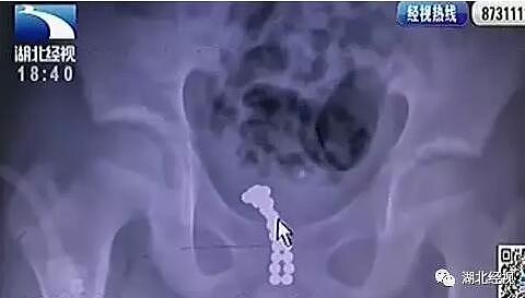 11岁男孩将26颗磁珠塞进尿道 切开膀胱后医生傻眼