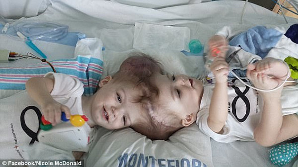 美国连颅双胞胎回家了 40人手术27小时（组图） - 2