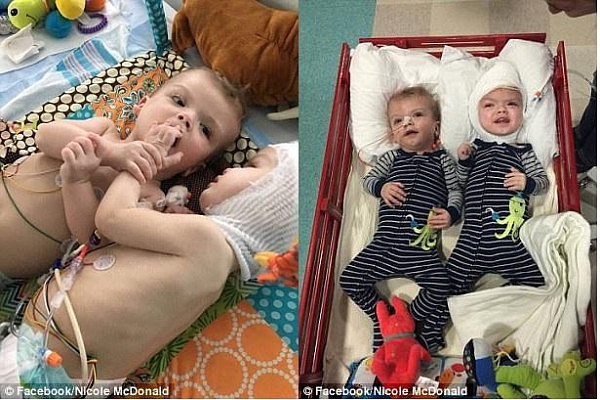 美国连颅双胞胎回家了 40人手术27小时（组图） - 4