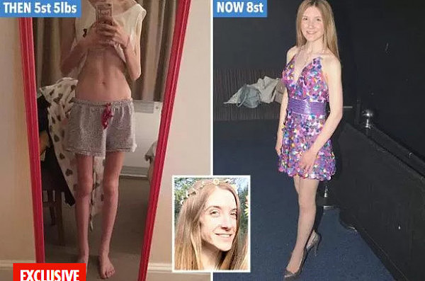 英国少女为拥有超模美腿 她暴瘦到68斤险丧命（组图） - 1