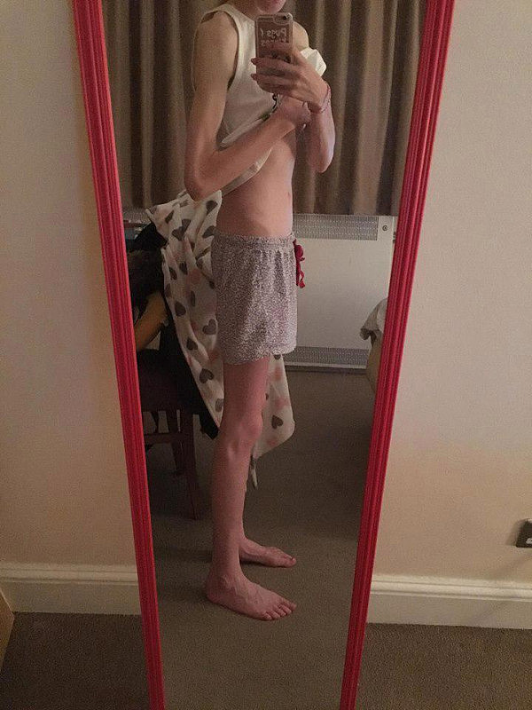 英国少女为拥有超模美腿 她暴瘦到68斤险丧命（组图） - 2