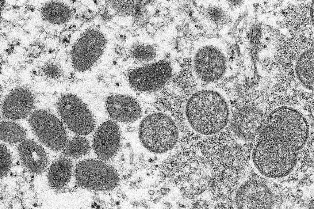 全美已有超1.4万例猴痘病例 纽约州报告首例未成年病例 - 1