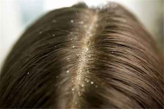 屑满净洗发水能去屑吗 头皮屑多的原因有哪些 - 1