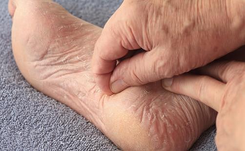 脚部干燥易脱皮教你护脚 脚脱皮的治疗方法有哪些 - 1