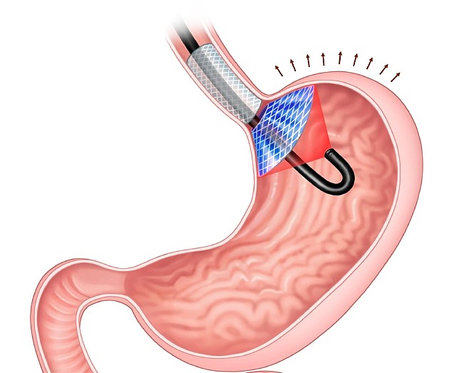 如图所示，图中蓝色和灰色部分是“胃内饱腹诱导装置(ISD)”植入物，它通过按压胃部产生饱腹感，当该植入物涂层被激光激活时，就会杀死产生饥饿激素的细胞。
