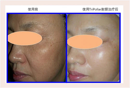 亚洲人皮肤三大特性：初普TriPollar射频美容仪提供针对性抗老解决方案 - 2