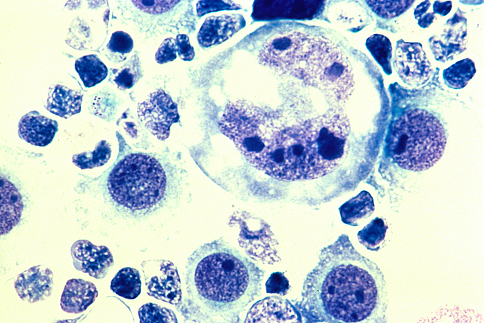 Lymphoma-Tumor-Cells.png