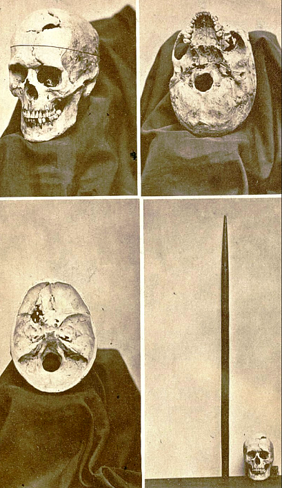 史上最传奇的头骨：被铁棒贯穿，被挖坟研究，最终登上 Science 封面 - 5