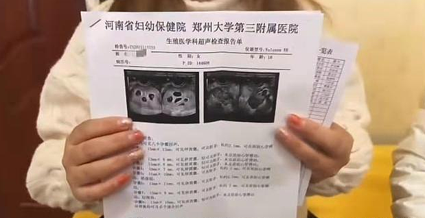 郑州怀八胞胎女子仅18岁 确实曾打促排卵针 - 1